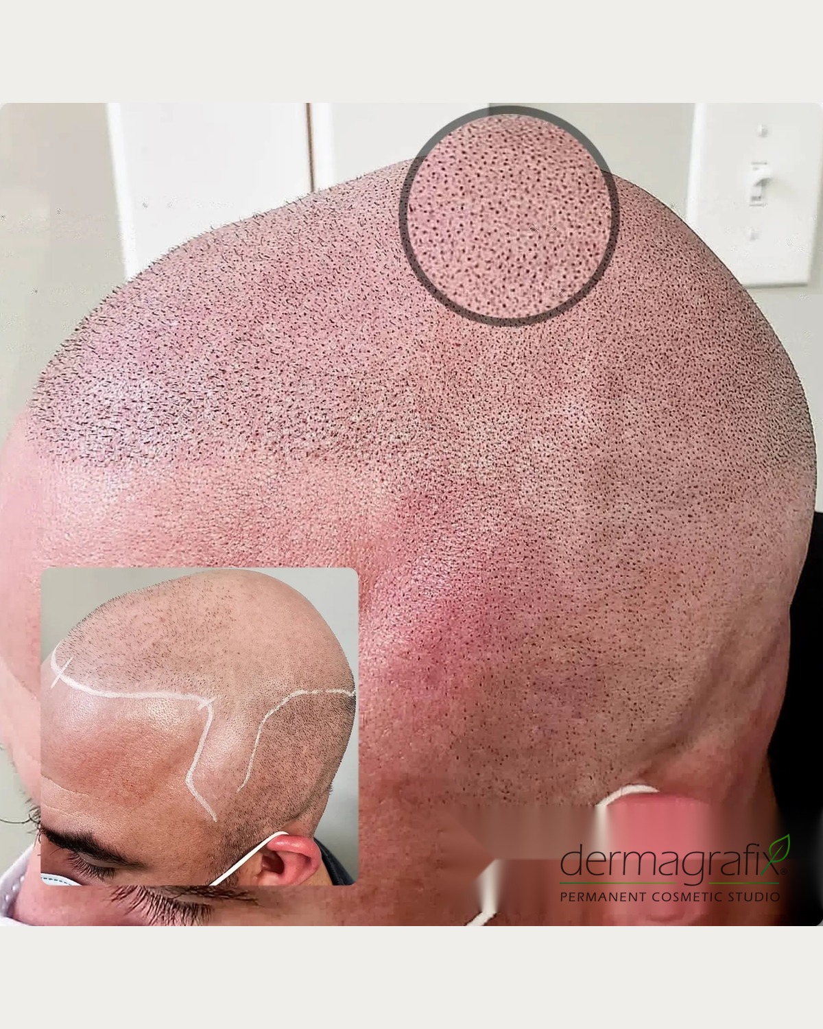 Scalp micropigmentation on a shaved head, showing the mapped hairline design and the healed follicle density across the crown