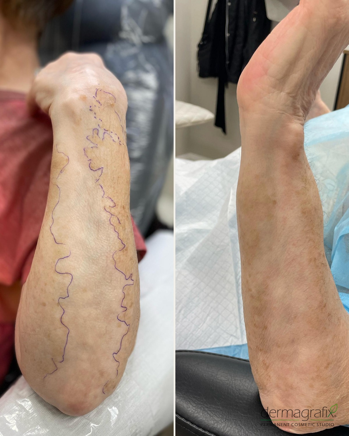 Left forearm with vitiligo patches outlined before treatment, shown beside the same forearm after three sessions of skin re-pigmentation matched to the surrounding tone