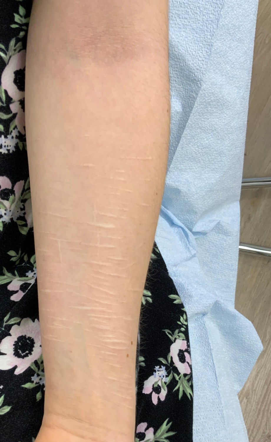 Client 1 forearm with pale linear scars before treatment