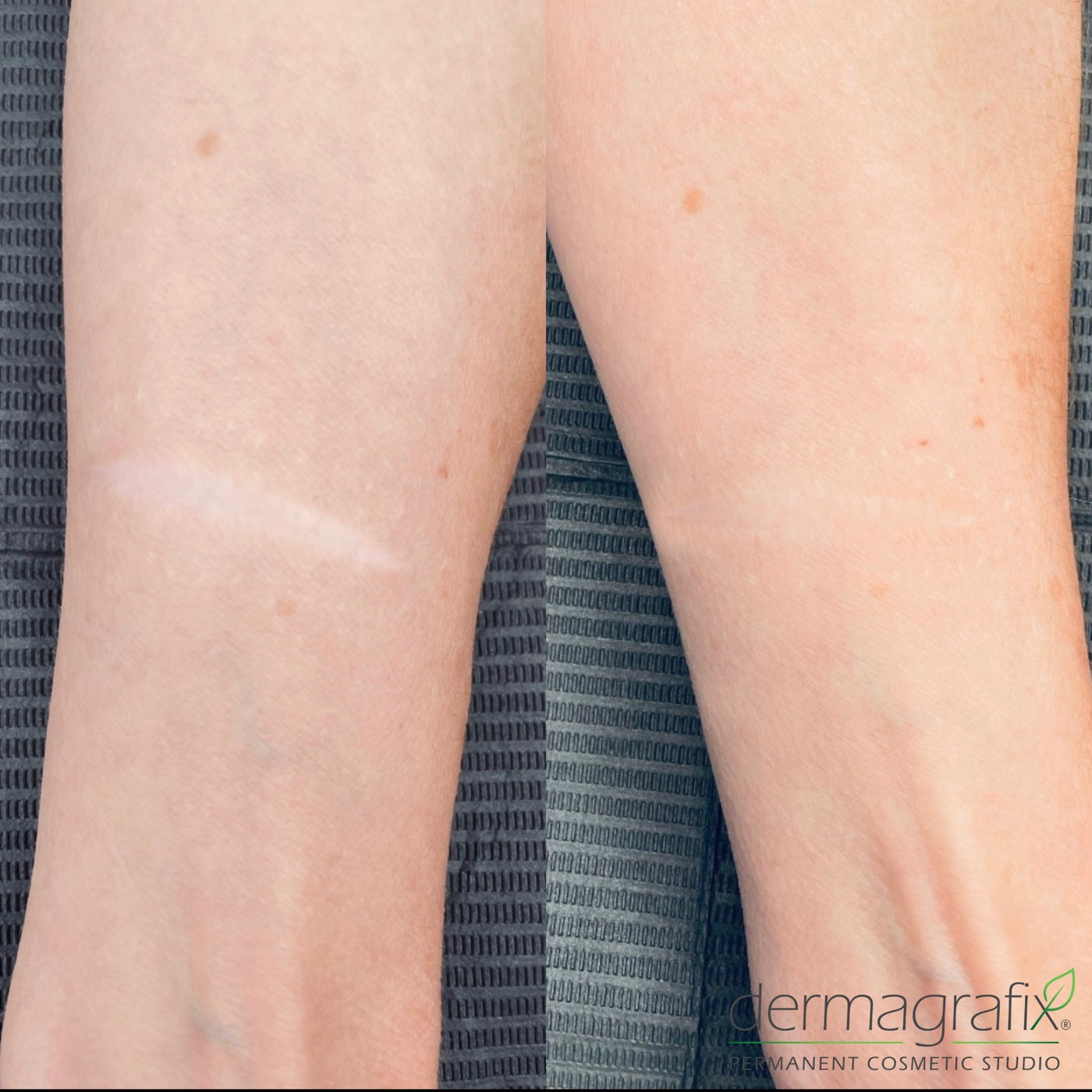 Linear wrist scar before and after scar camouflage tattooing blended into the surrounding skin