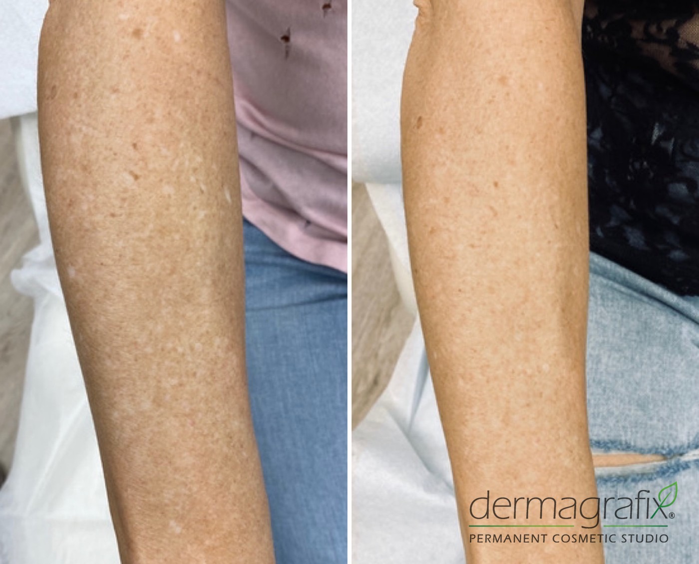 Pale, hypopigmented area on the forearm before and after skin re-pigmentation tattooing matched to the surrounding tone