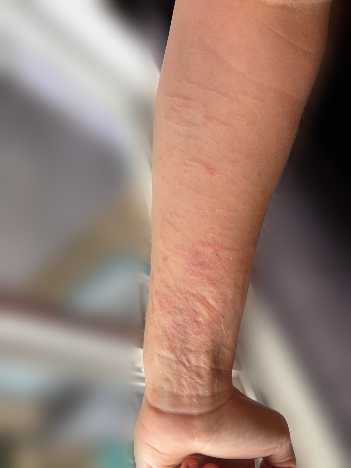 Client 2 forearm right after a session with pink scar lines
