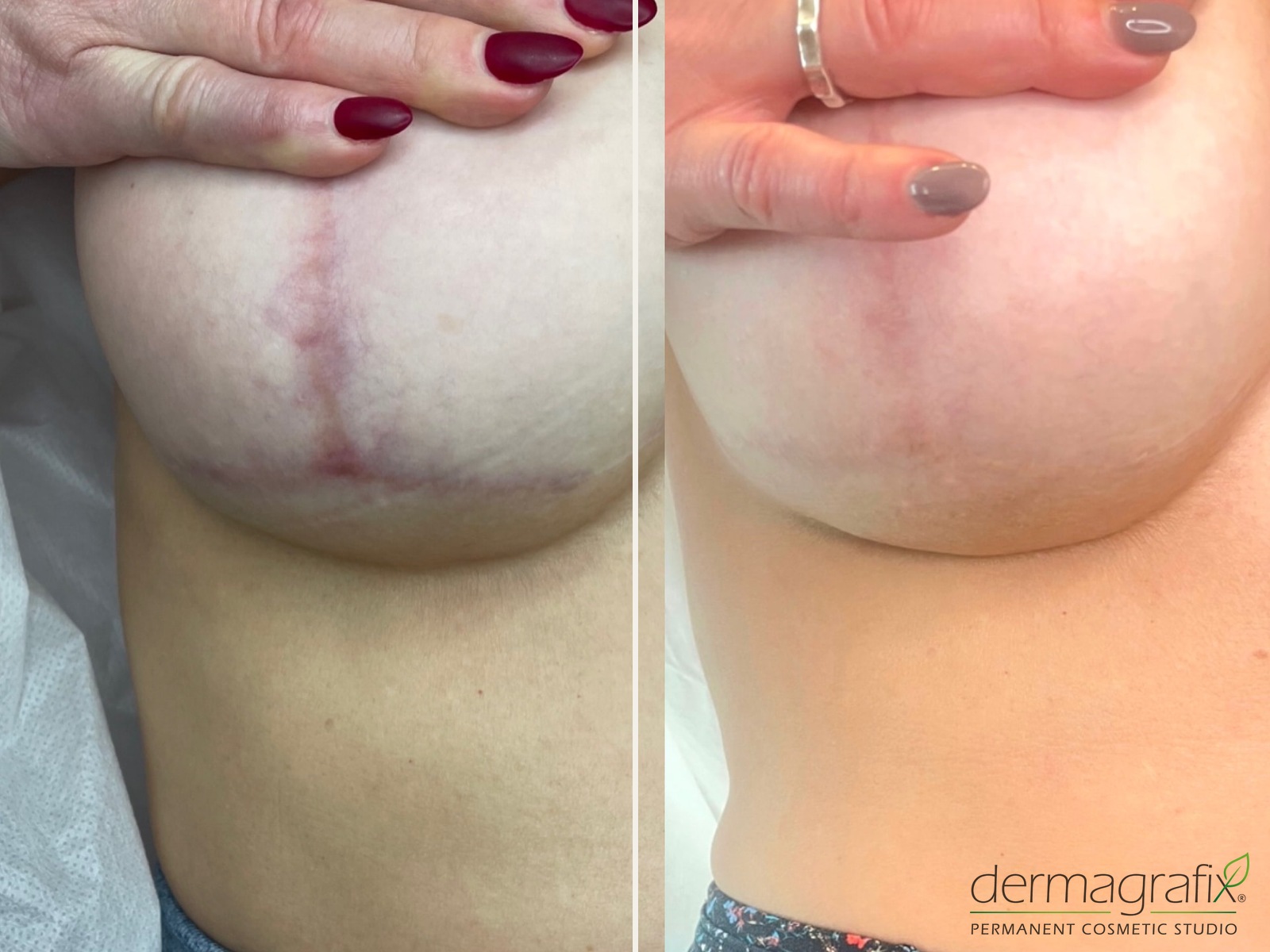 Breast lift scar before and after ink-less scar revision, with the vertical and anchor scar lines noticeably paler and flatter