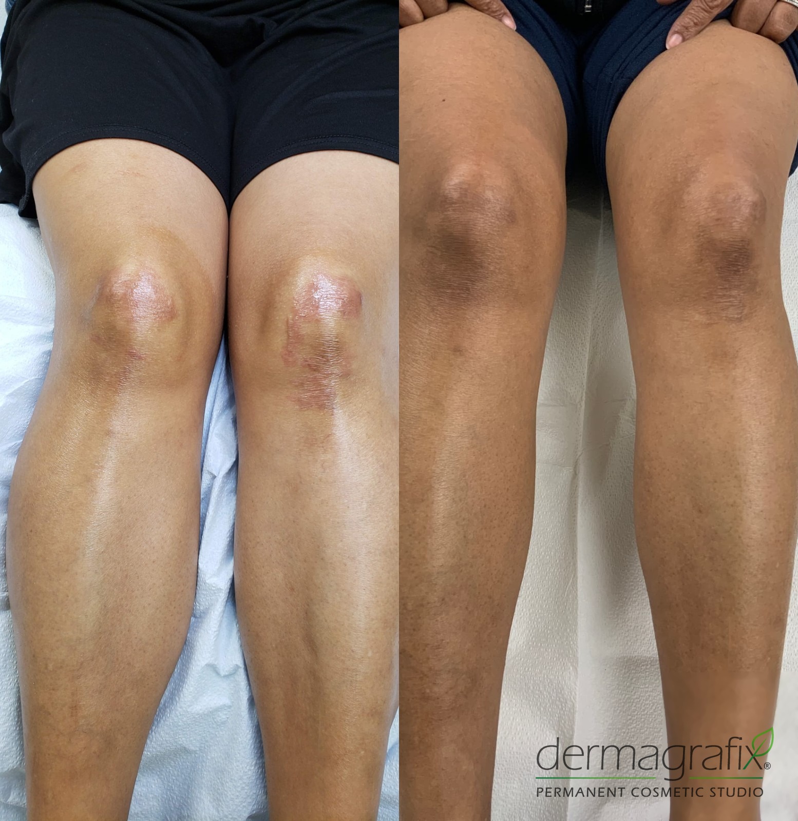 Raised, discoloured scarring across both knees before and after scar camouflage tattooing, blended into the surrounding skin tone