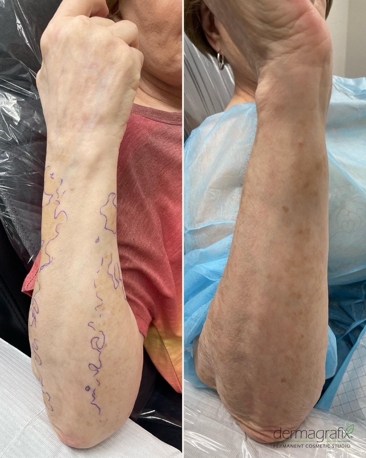 Right forearm with vitiligo mapped in surgical marker before treatment, shown beside the same forearm after three sessions of camouflage tattooing blended into the surrounding skin tone