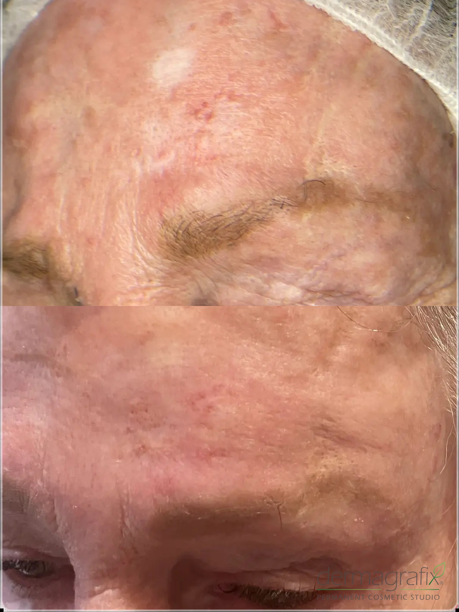 MOHS surgical scar on the forehead before and after scar concealment tattooing