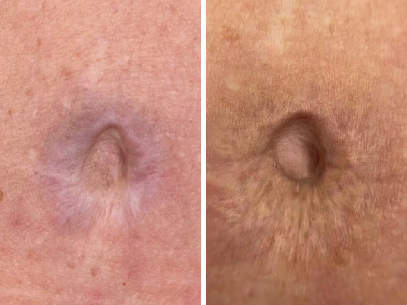 Localised scar before and after scar re-pigmentation tattooing