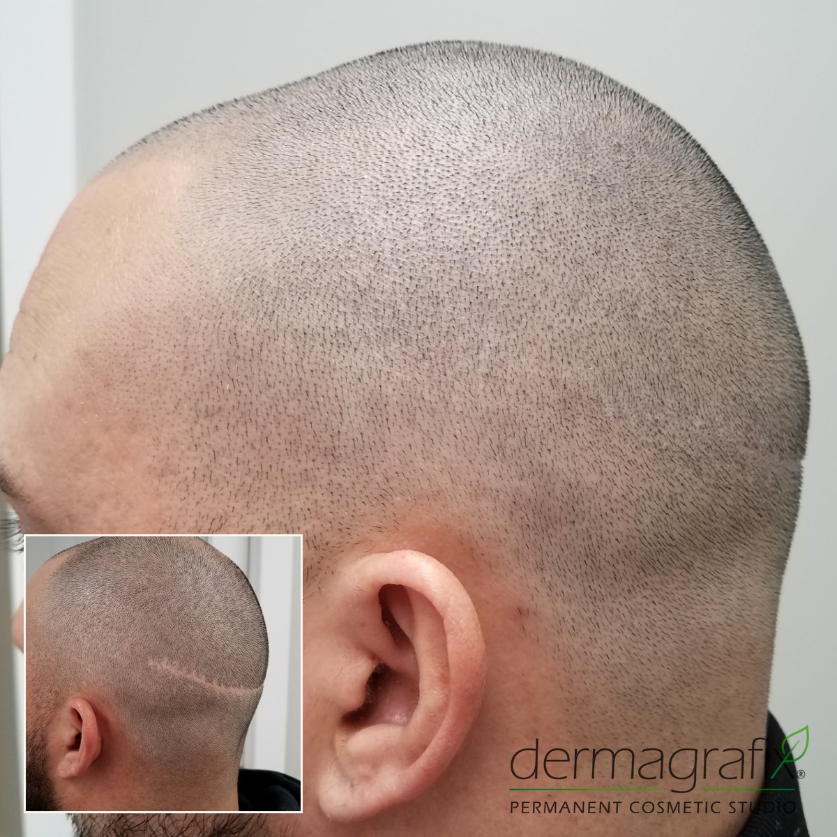 Scalp micropigmentation concealing a horizontal strip donor scar on a closely shaved head