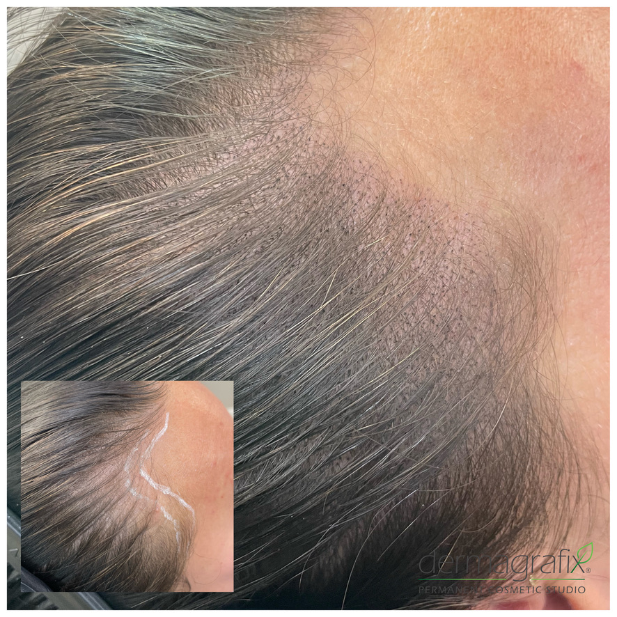 Scalp micropigmentation concealing a fine surgical scar along the hairline and temple
