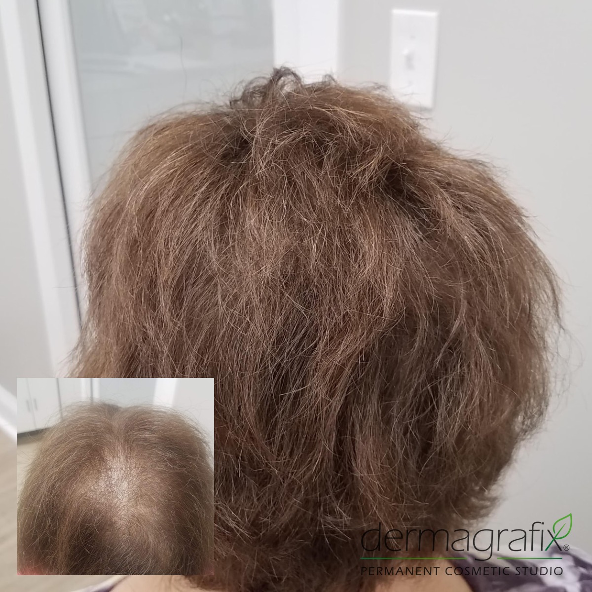 Scalp micropigmentation adding density through diffuse thinning at the crown for a woman with light brown hair