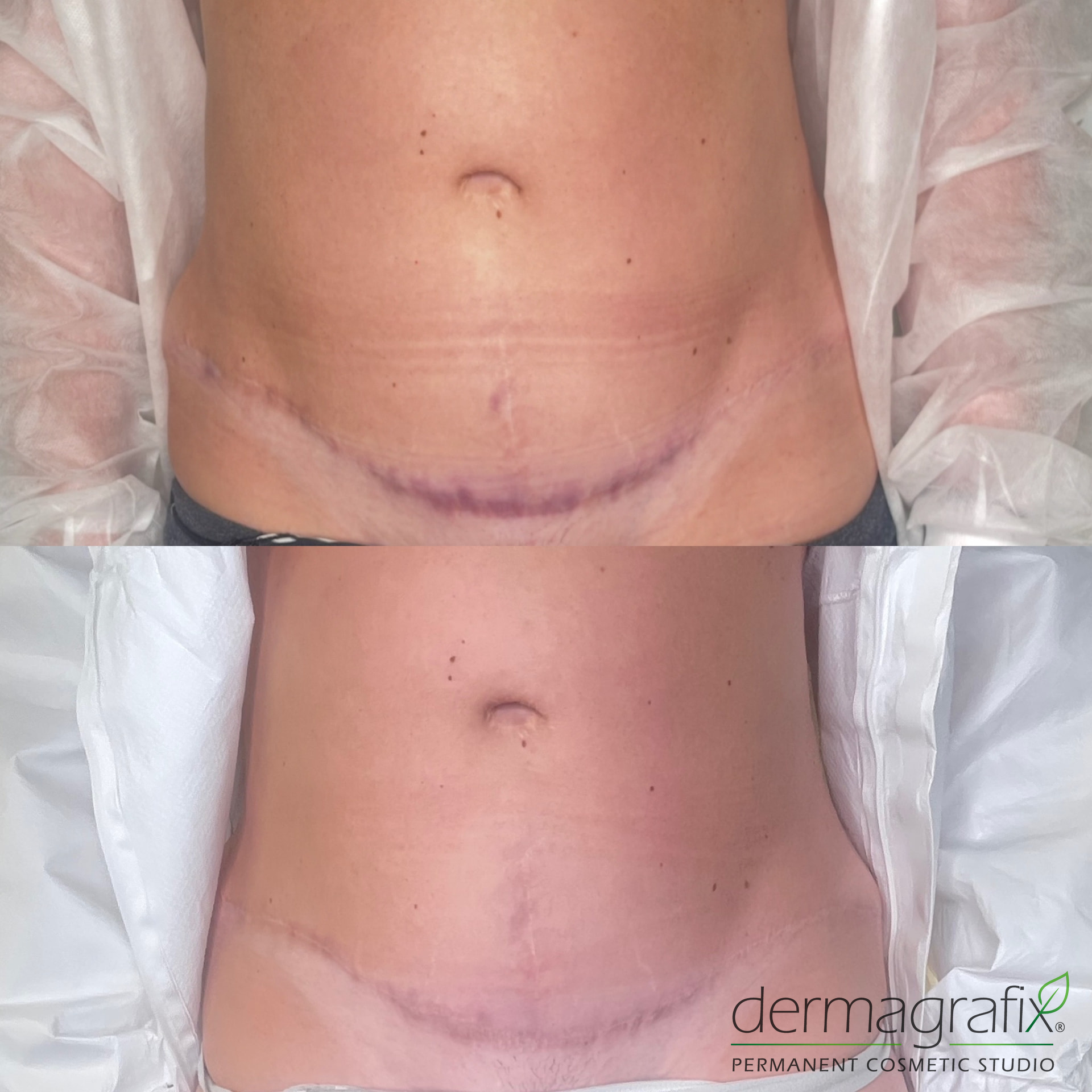 Abdominal surgical scar before and after ink-less needling, showing a flatter and less defined line
