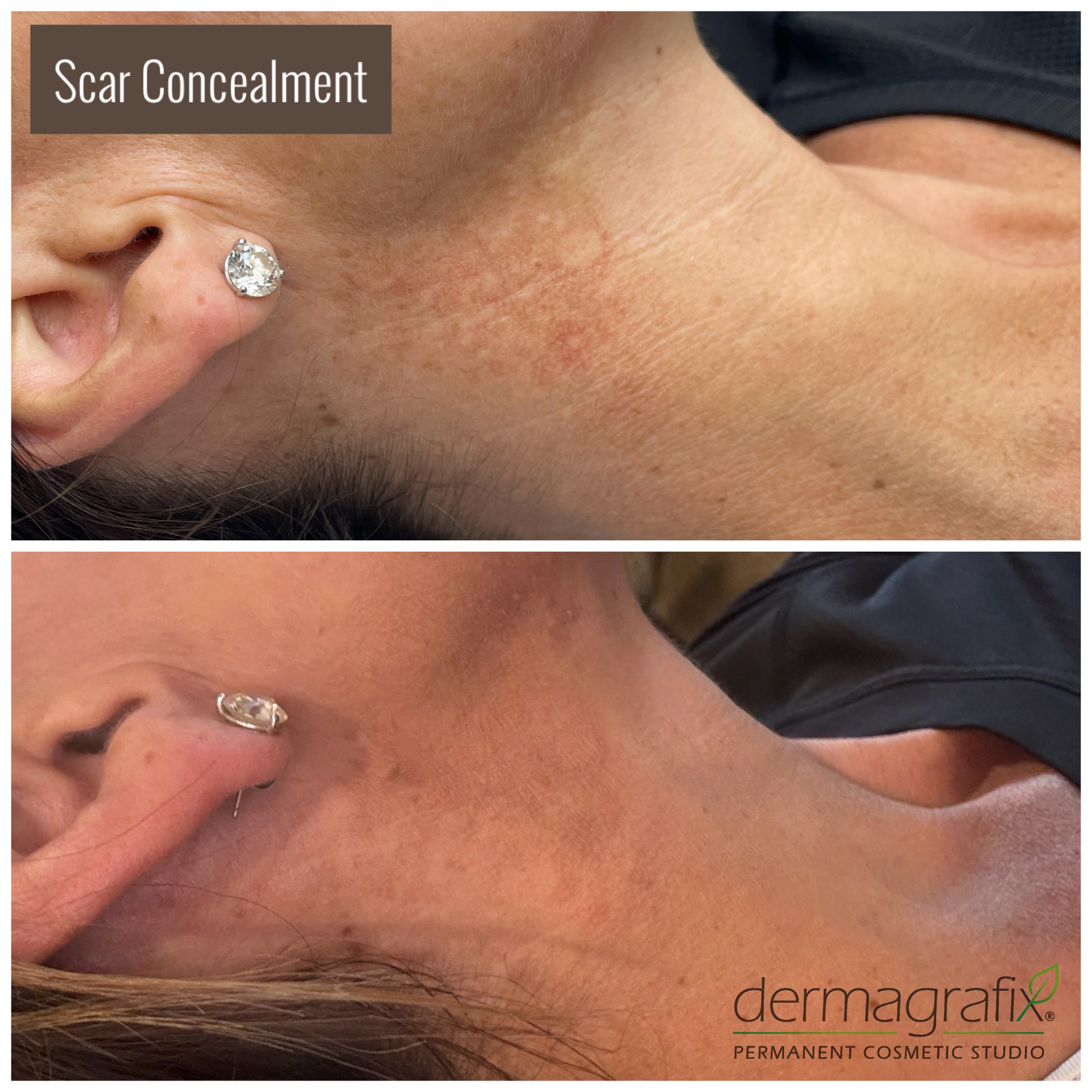 Scarring along the neck and jawline before and after scar concealment tattooing, blended into the surrounding skin tone