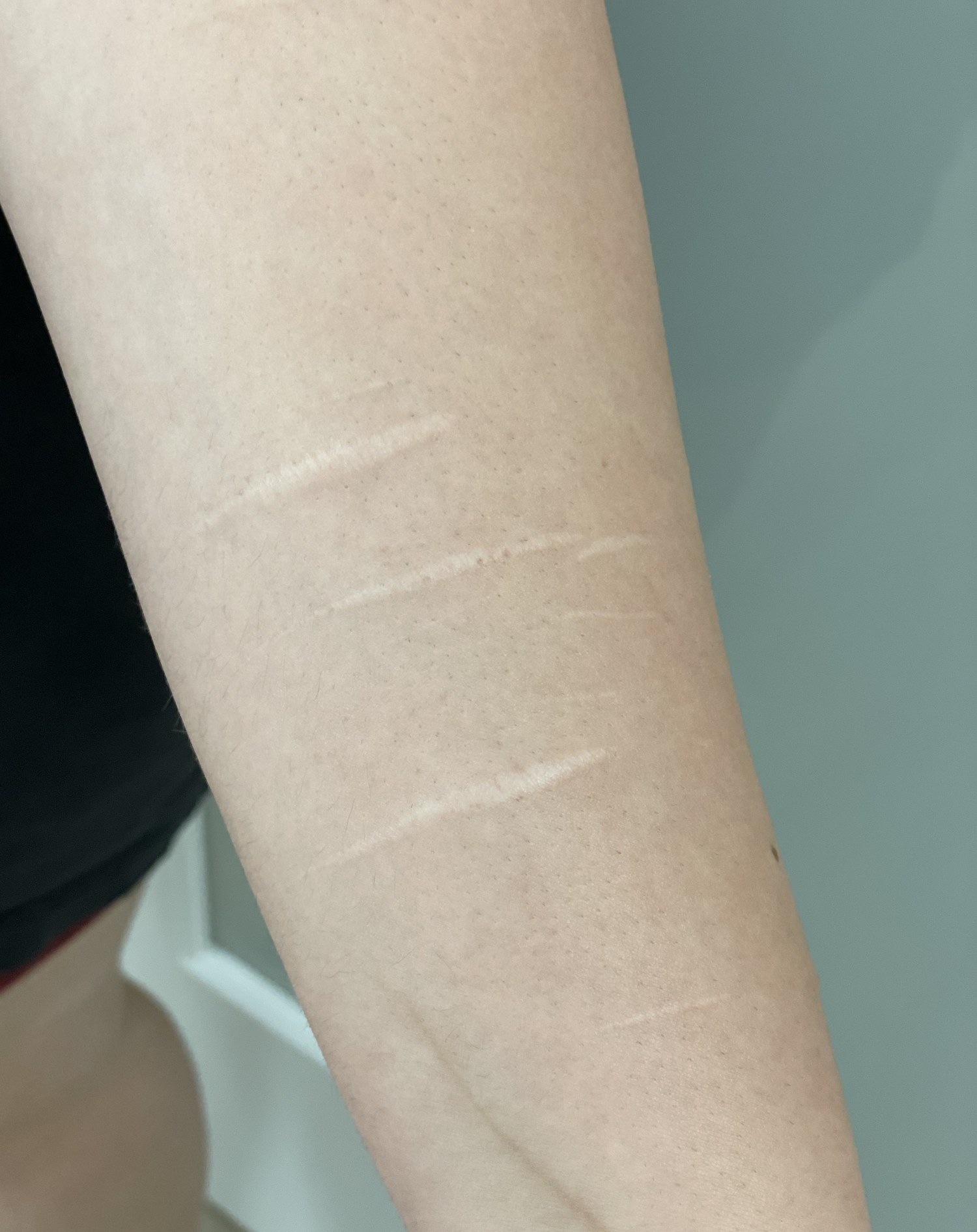 Client 3 forearm with faint linear scars before treatment