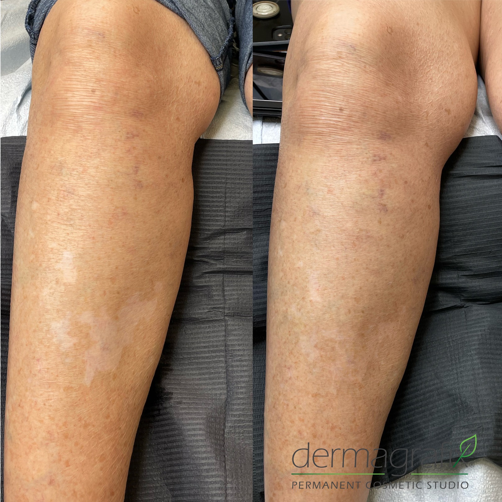 Vitiligo patches on the lower legs before and after skin re-pigmentation tattooing, blended into the surrounding freckled skin tone