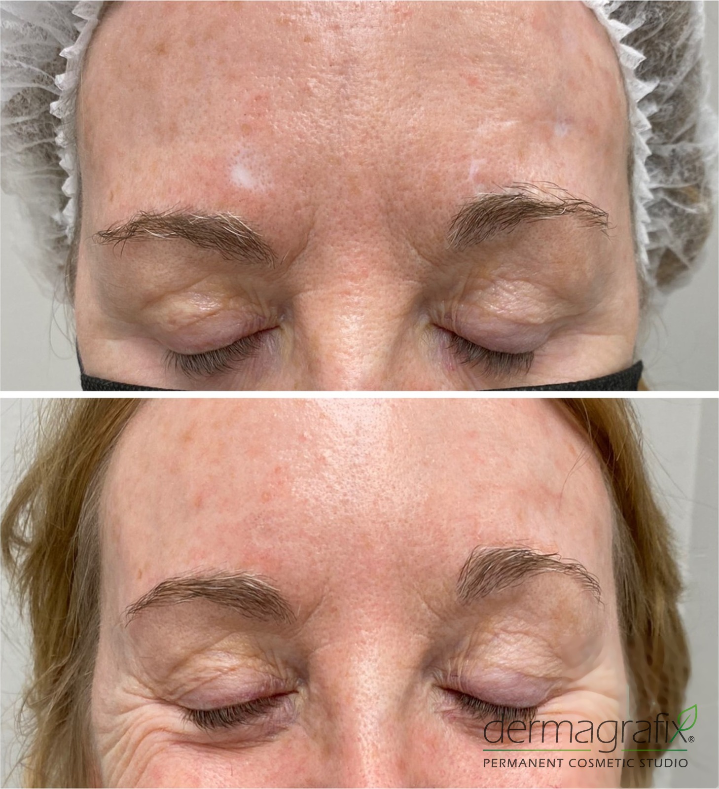 Scar above the brow before and after scar re-pigmentation tattooing