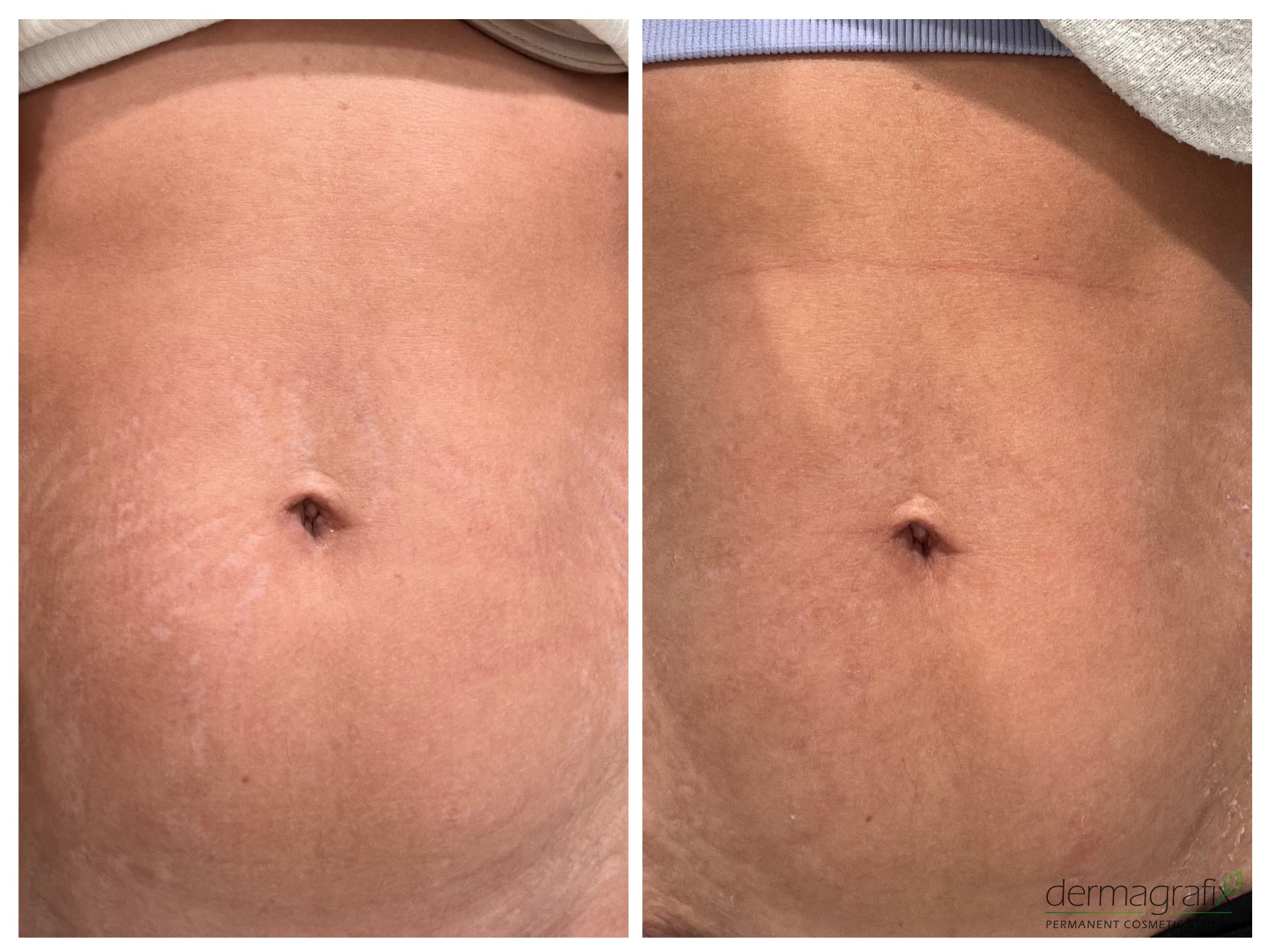 Abdominal stretch marks before and after skin camouflage tattooing, with pigment matched to the surrounding tone