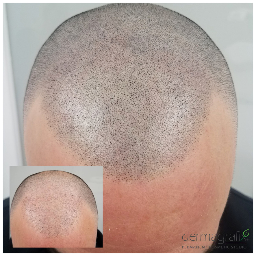 Scalp micropigmentation on a closely shaved head, rebuilding density across the crown and hairline