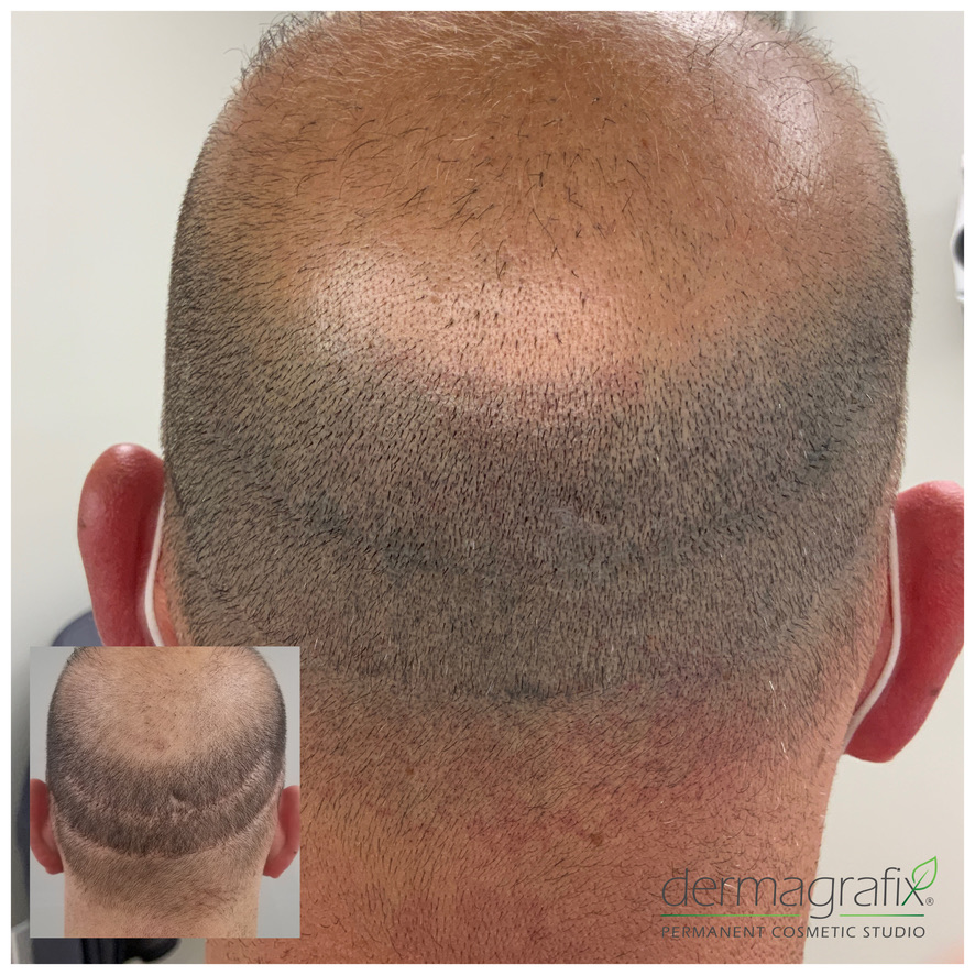 Scalp micropigmentation blending a transplant donor scar across the back of the head