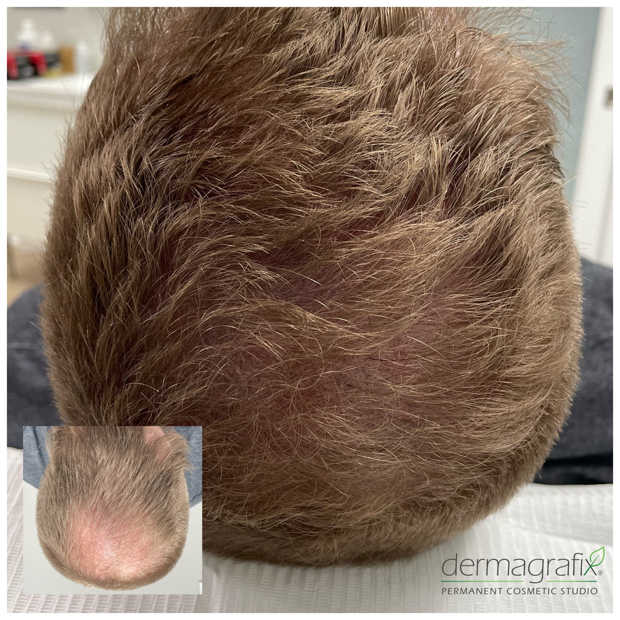 Scalp micropigmentation adding density beneath existing hair at the crown of a man with light brown hair