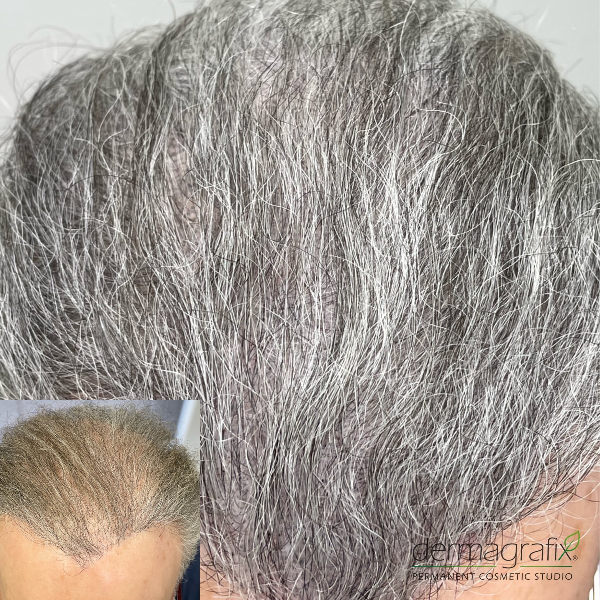 Healed scalp micropigmentation restoring a hairline