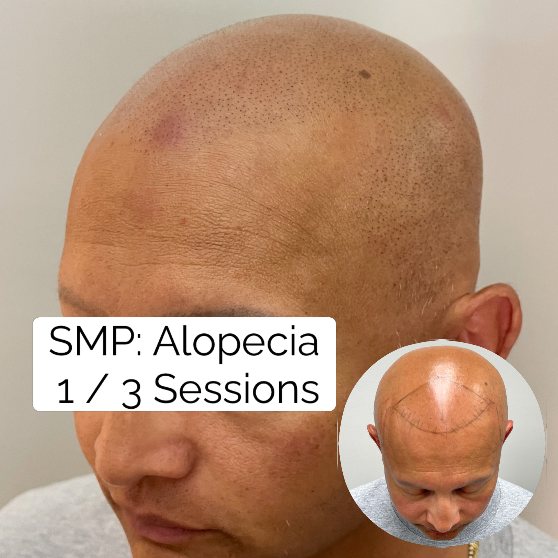 Scalp micropigmentation for alopecia after the first of three sessions, with softly replicated follicles across the hairline