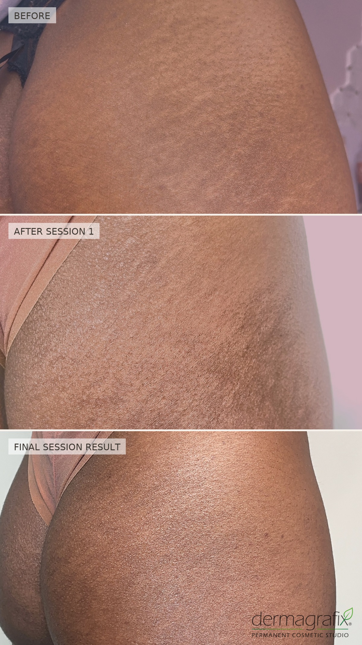 Stretch marks across the buttock and hip shown before treatment, after one ink-less session, and after the final session, with smoother texture and more even tone