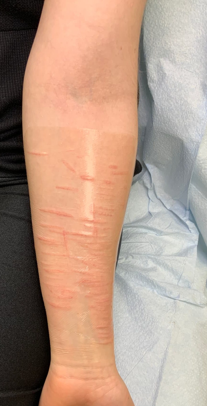 Client 1 forearm right after a session, lines red under a clear dressing