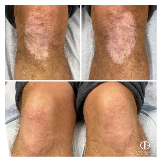 Vitiligo patch on a knee before and after skin re-pigmentation tattooing, blended into the surrounding skin tone
