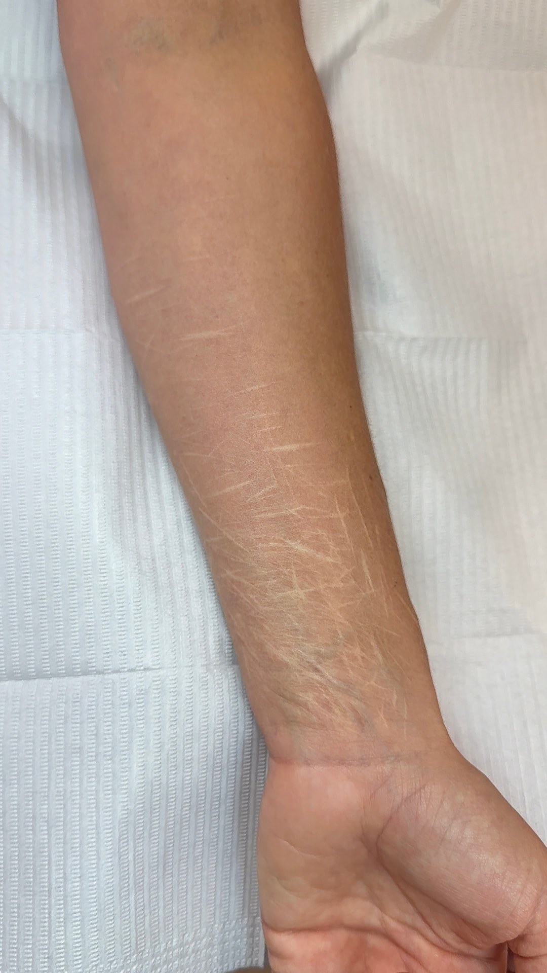 Client 2 forearm with linear scars before treatment