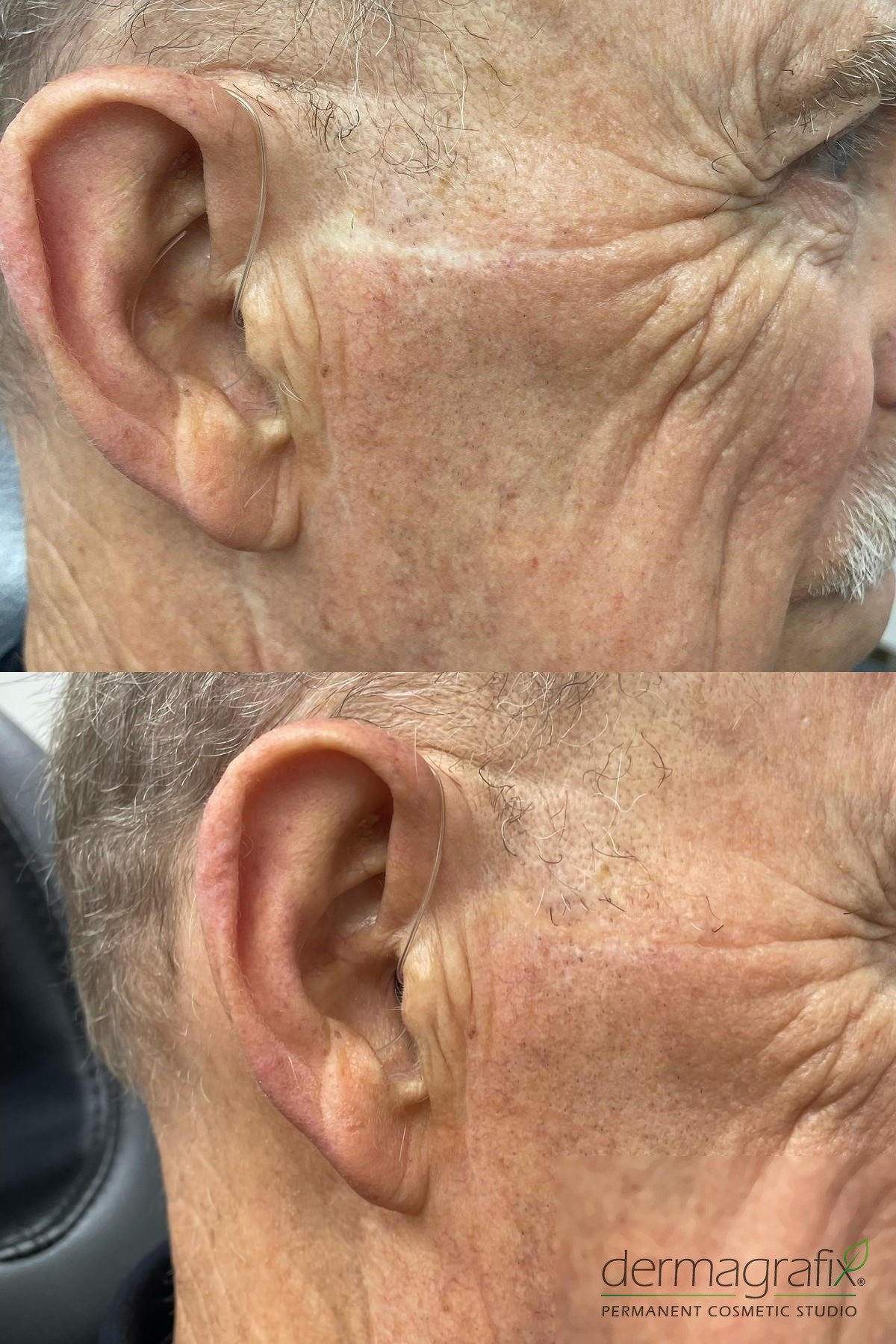 Scarring in front of the ear and temple before and after skin re-pigmentation tattooing