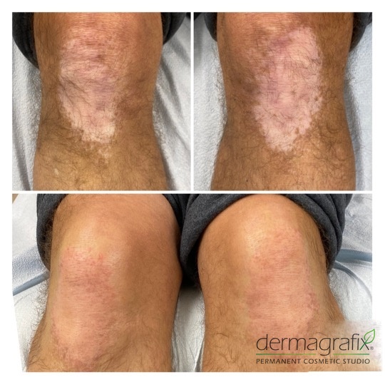 Hypopigmented scarring on a knee before and after skin re-pigmentation tattooing, blended into surrounding skin tone
