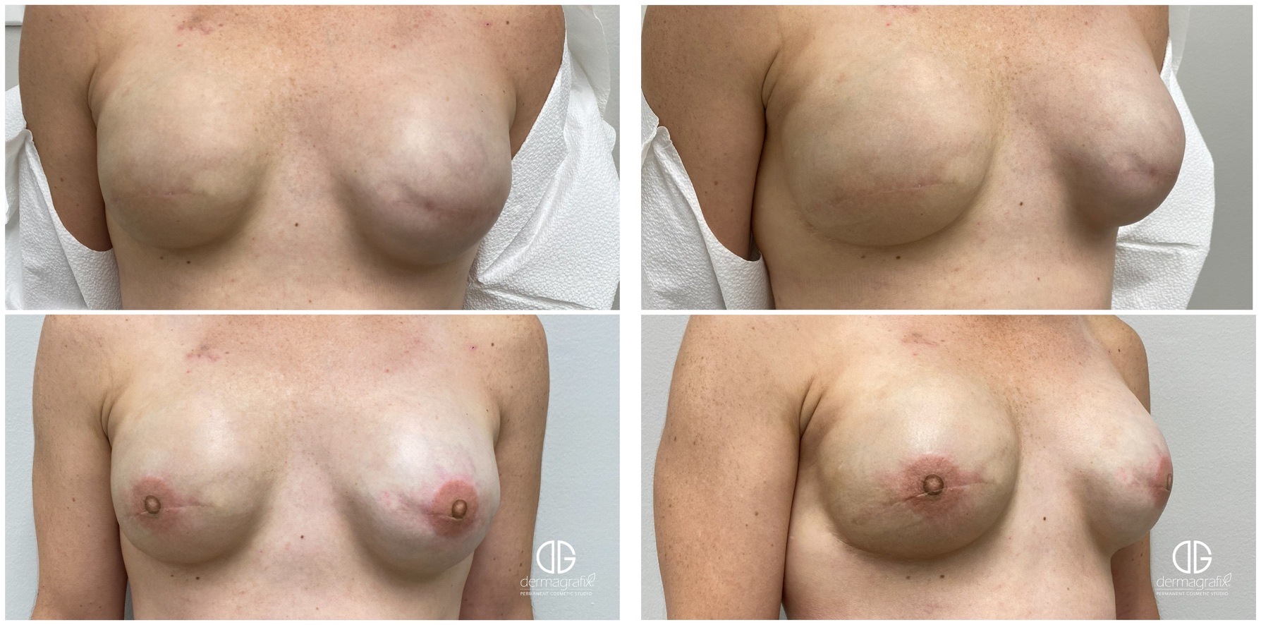 Bilateral mastectomy reconstruction before and after 3D areola and nipple restoration tattooing, shown front-on and at an oblique angle