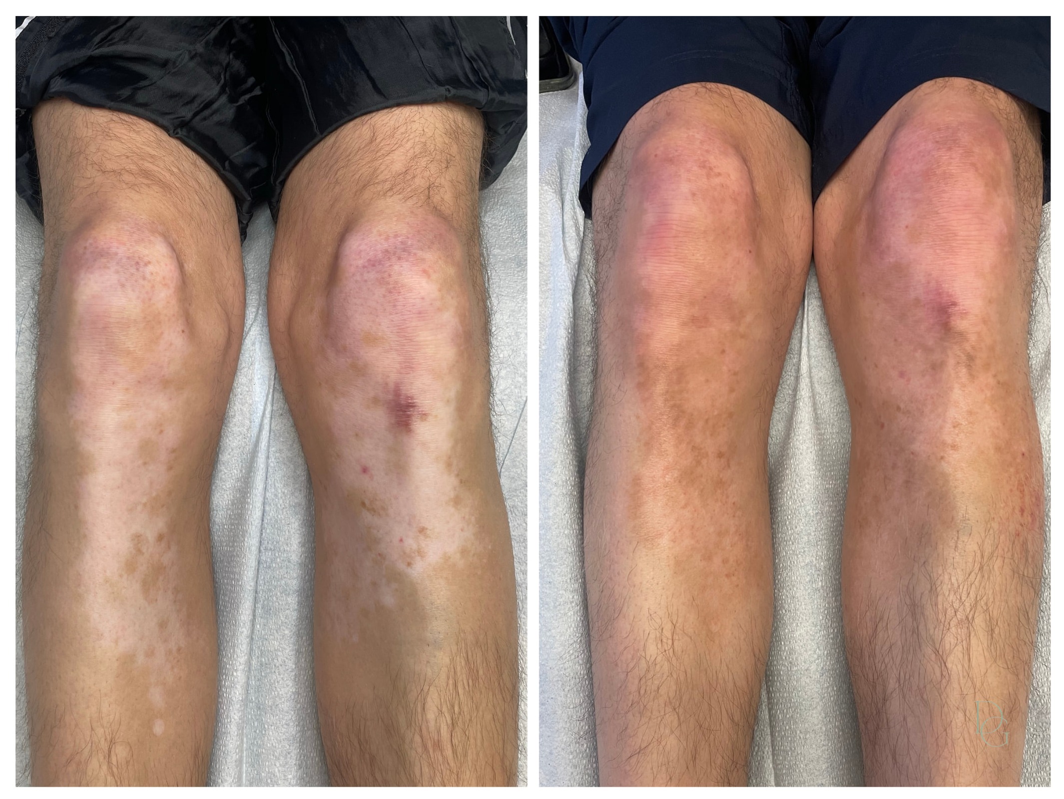 Vitiligo and pigment loss across the knees and shins before and after skin re-pigmentation tattooing matched to the surrounding tone