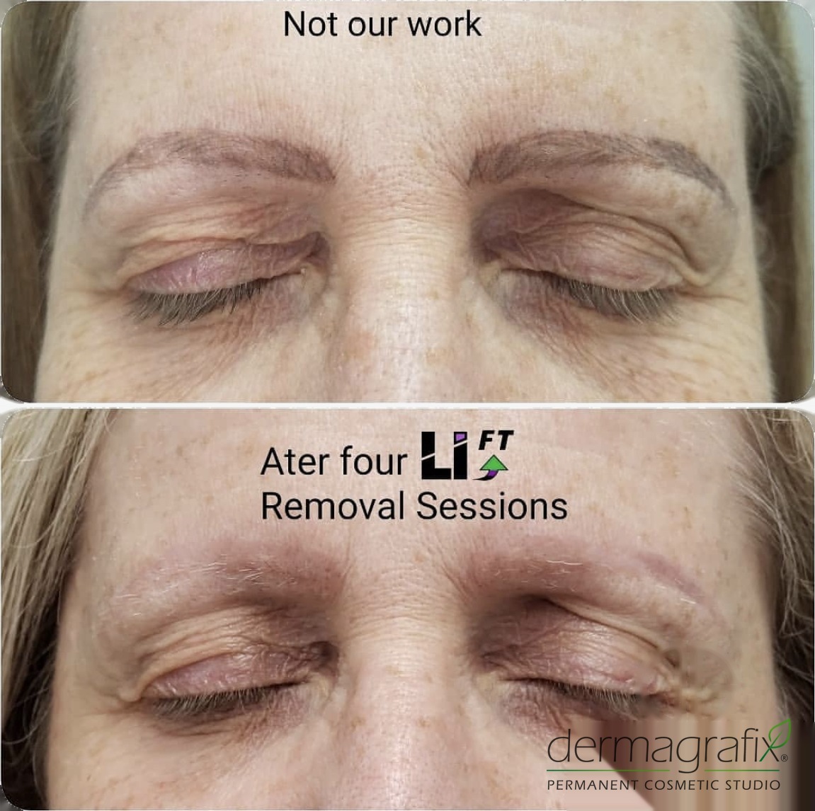 Microbladed brows before and after four LiFT removal sessions, with the old pigment significantly lightened