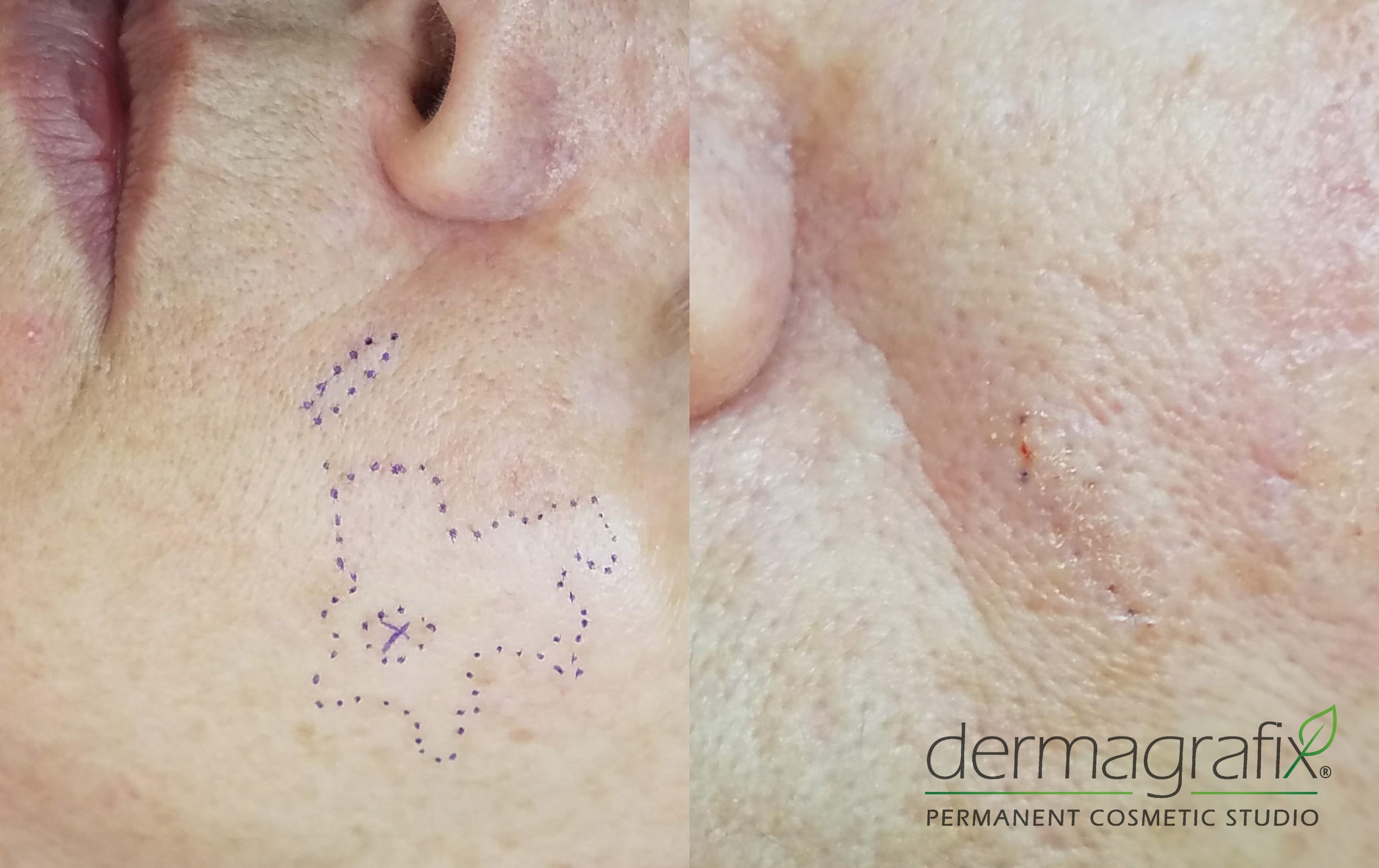 Cheek scar before and after layered scar camouflage tattooing