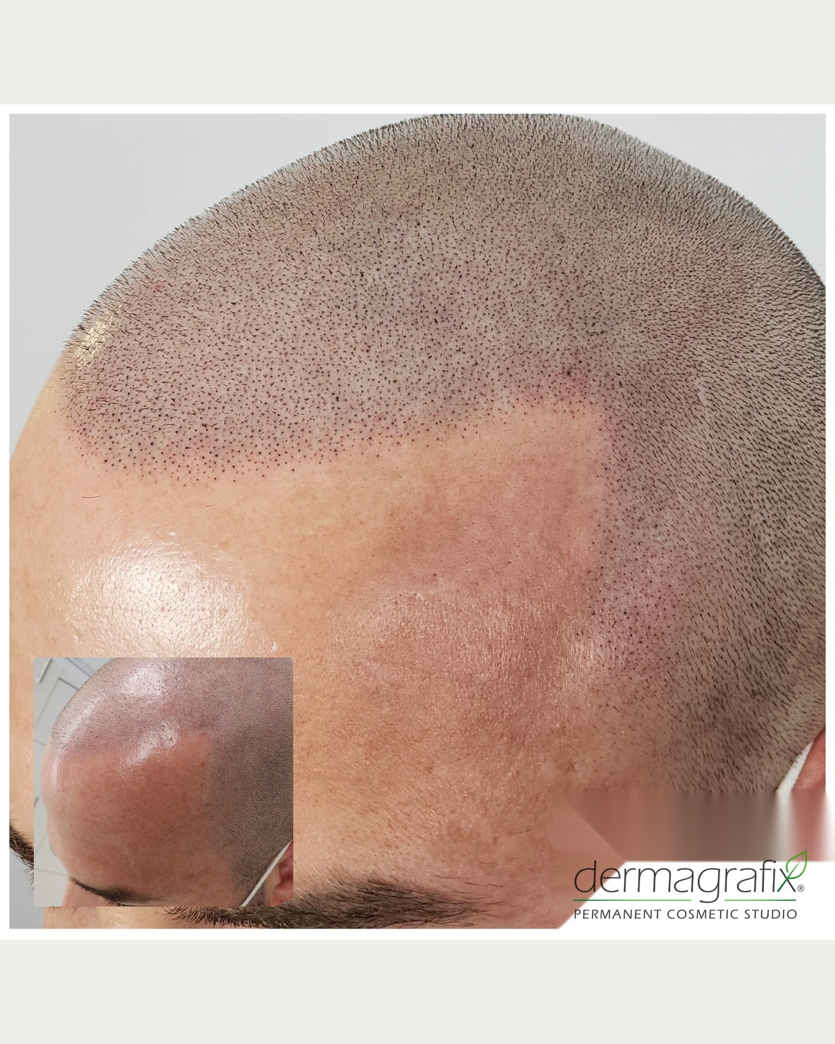 Scalp micropigmentation softening a scar and rebuilding a defined hairline on a closely shaved head