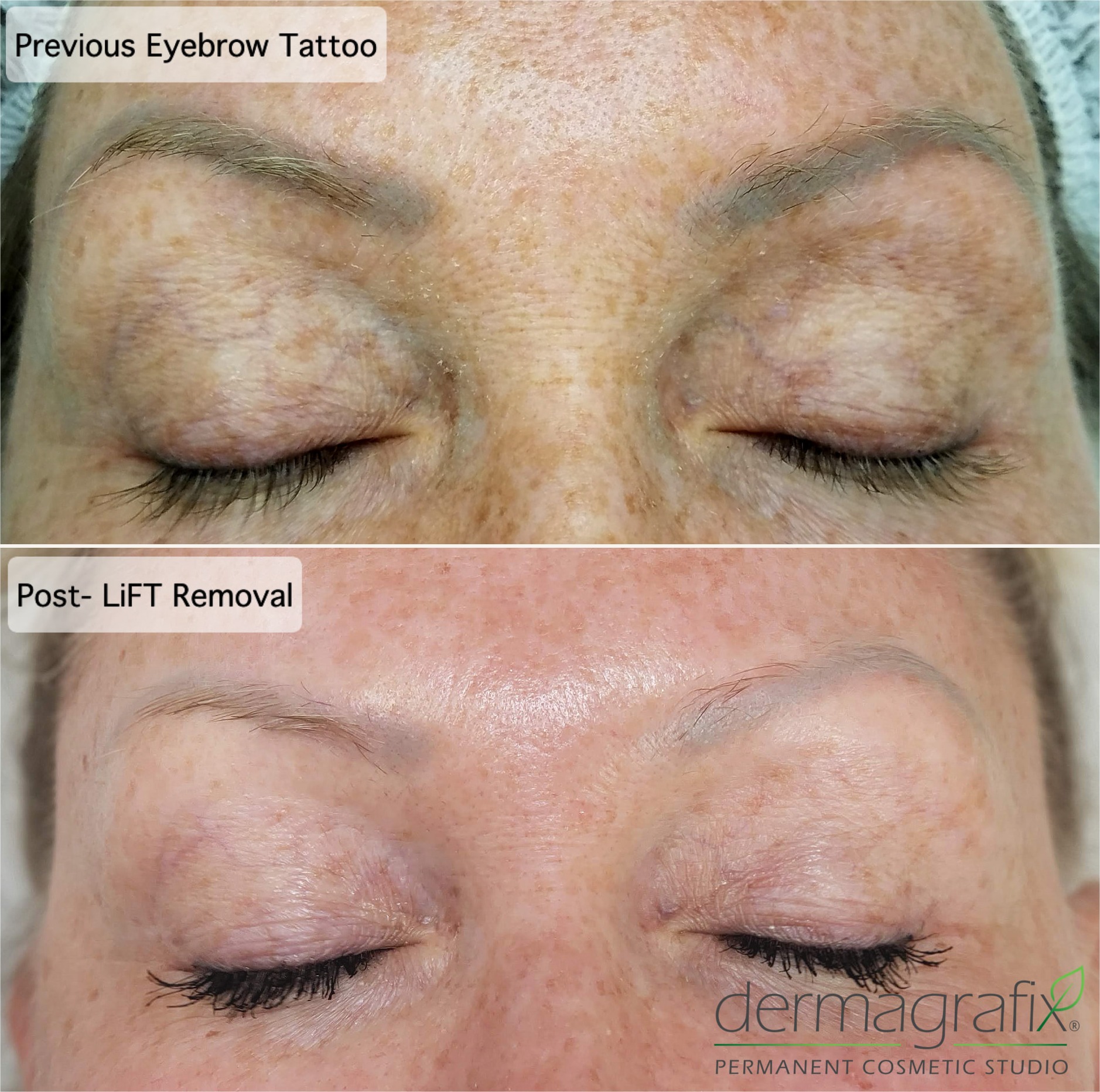 Previous eyebrow tattoo before and after LiFT tattoo removal, showing the old pigment lifted from the brows