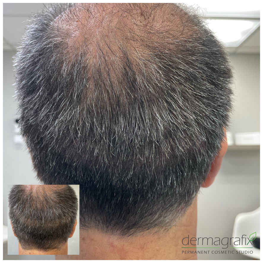 Scalp micropigmentation adding density at the vertex of a man with salt and pepper hair
