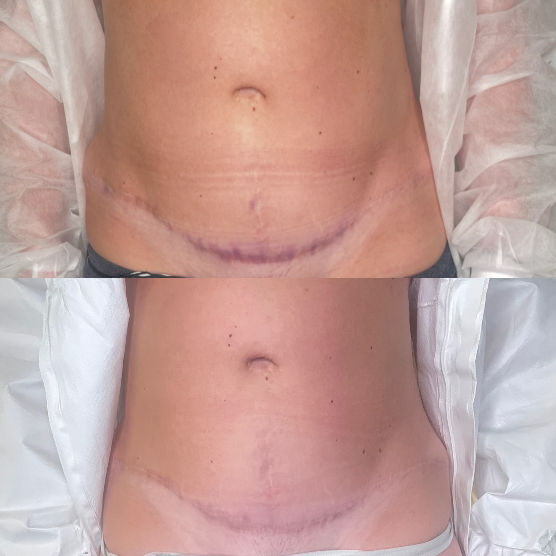Abdominal surgical scar before and after ink-less needling, showing a flatter and less defined line