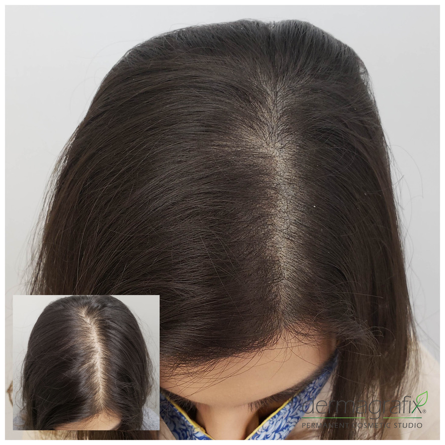 Scalp micropigmentation adding density through the part and crown for a woman with dark hair