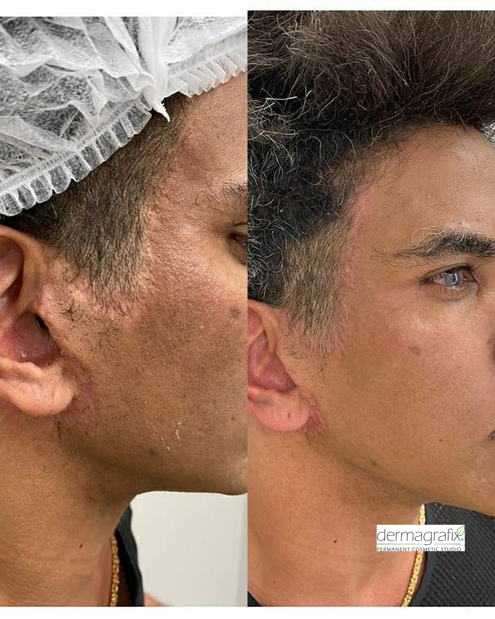 Facelift incision scarring across the sideburn, cheek, and jawline before and after scar camouflage tattooing