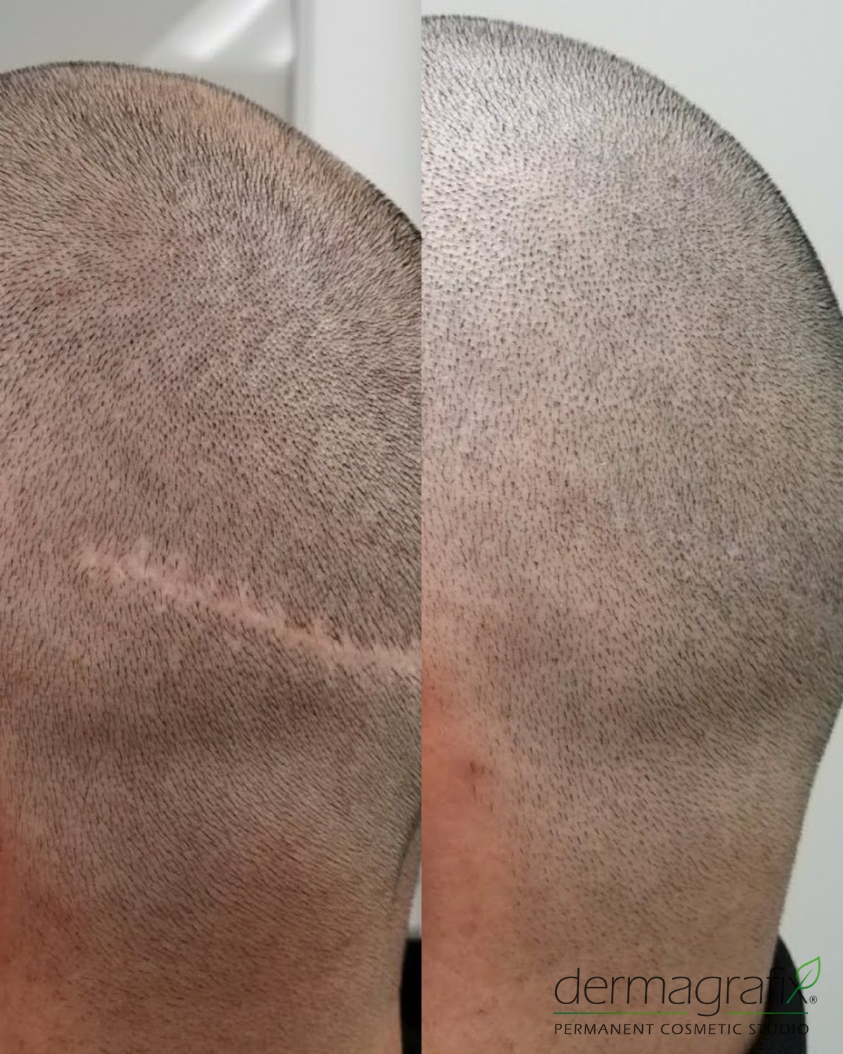 FUT strip transplant scar before and after scalp micropigmentation camouflage