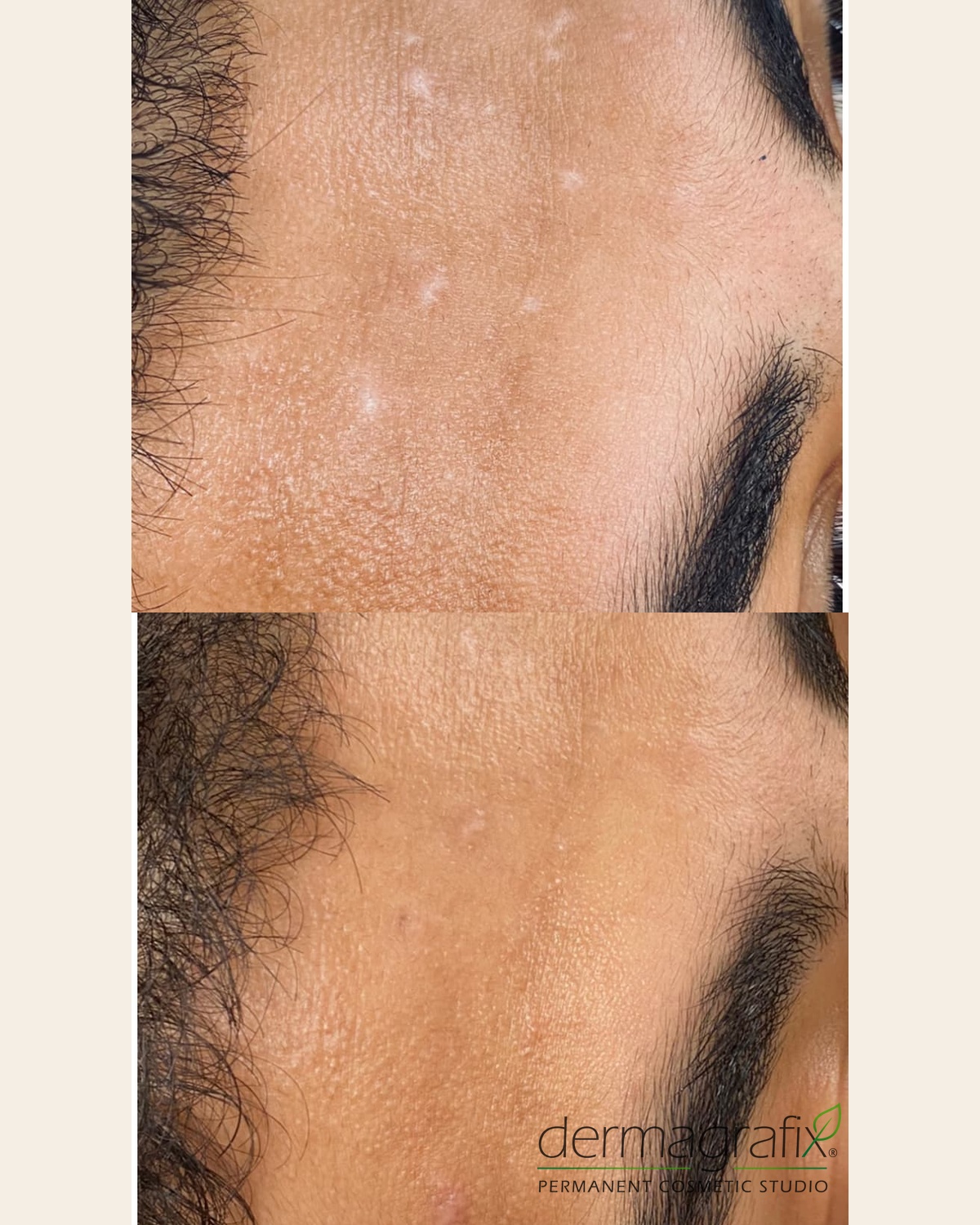 Forehead scar before and after ink-less scar needling, with softened texture and more even tone