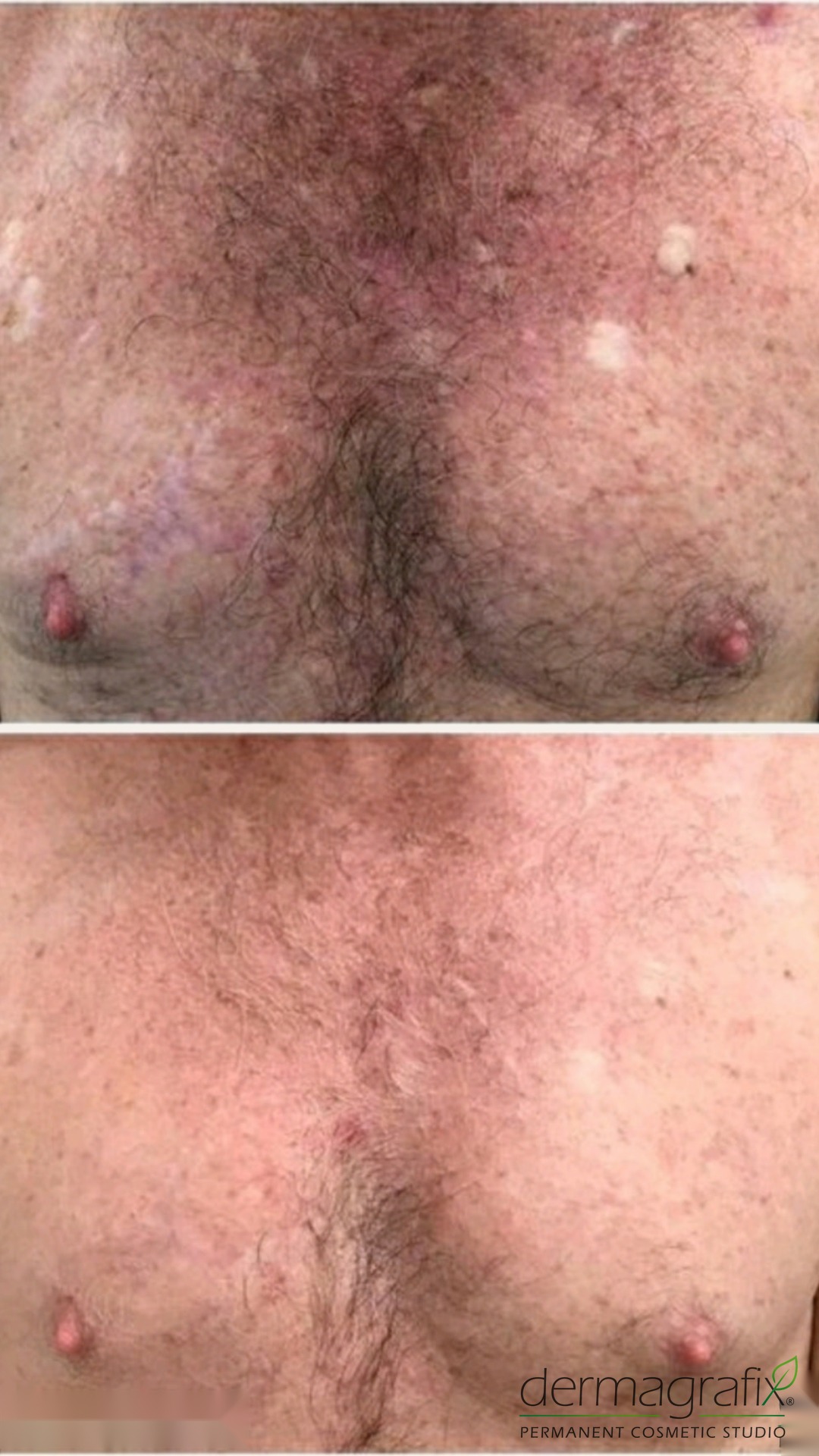 Vitiligo camouflage across the chest, blended into the surrounding skin tone