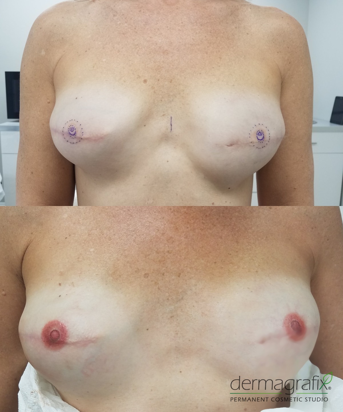 Bilateral mastectomy reconstruction shown with areola placement mapping and again after healing