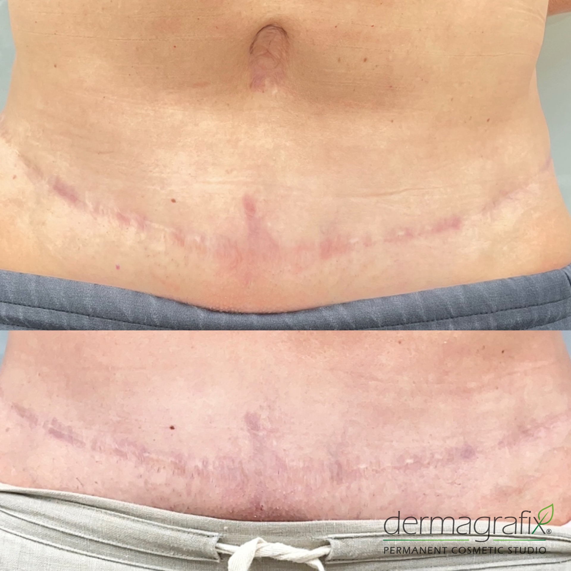Raised, discoloured abdominal surgical scar shown before and after ink-less scar revision, with softened texture and reduced redness