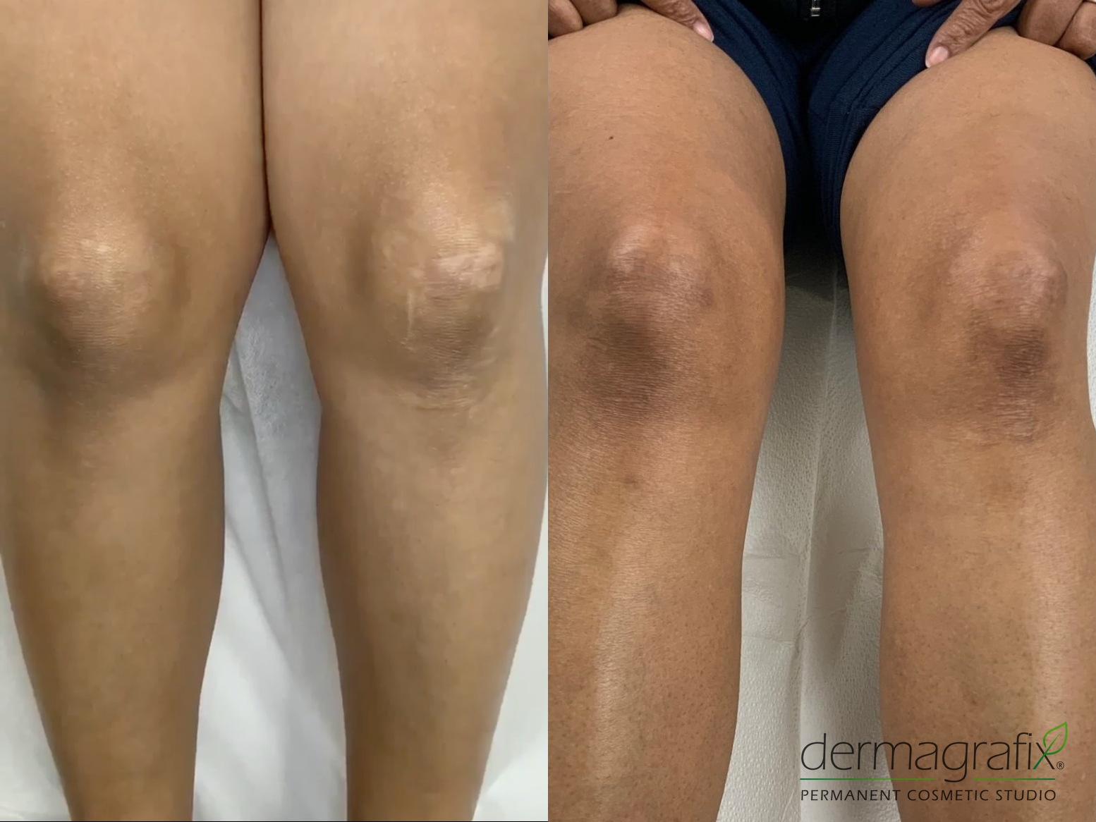Knee scarring before and after scar camouflage colour matched to the surrounding skin tone