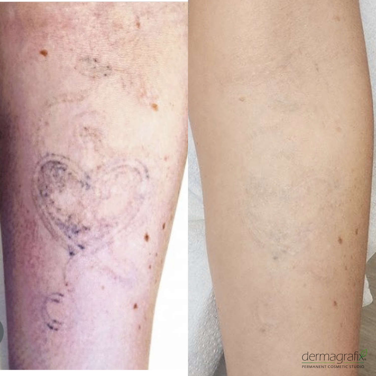 Forearm tattoo before and after saline Lift removal sessions