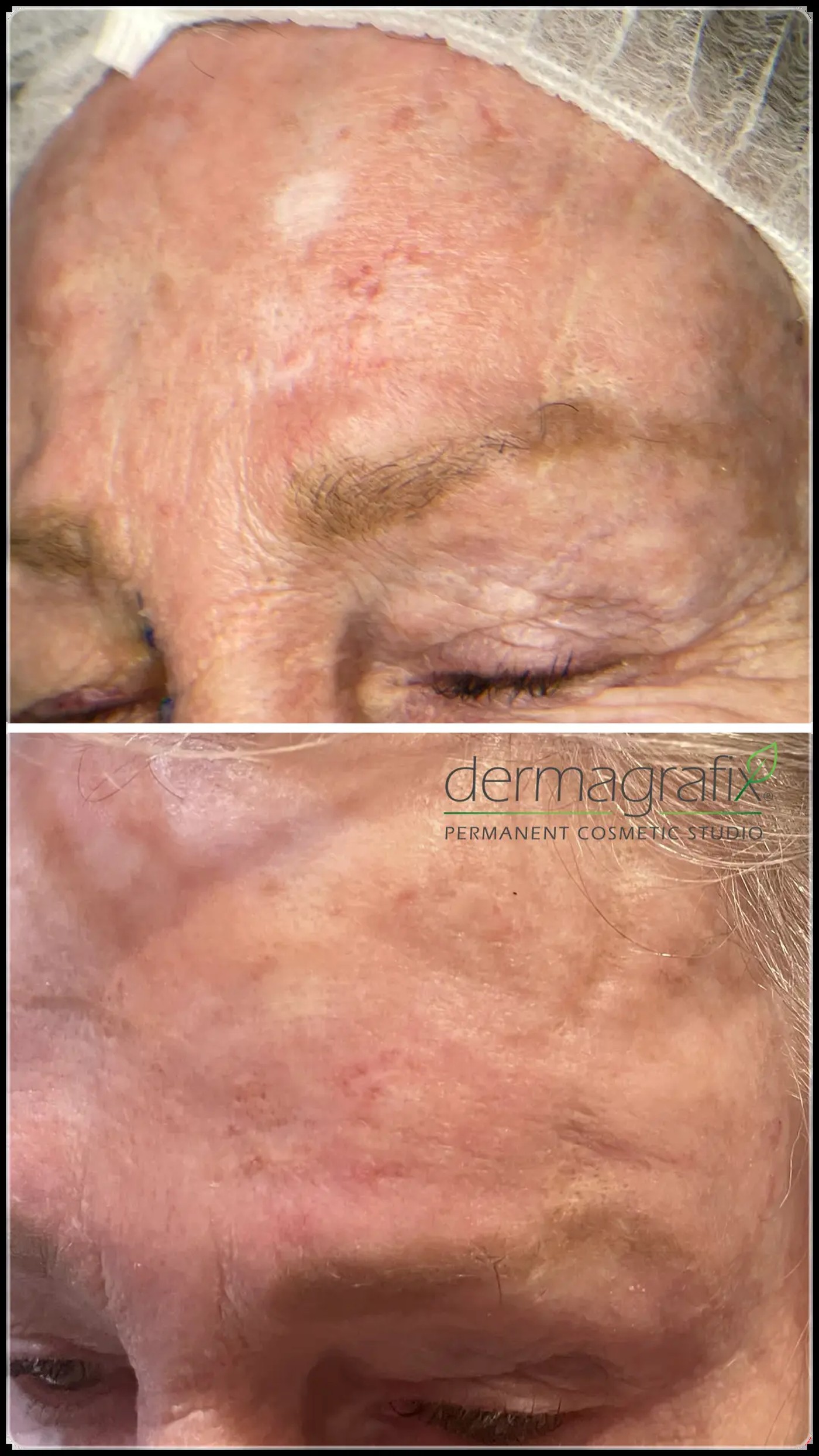 MOHS surgical scar on the forehead before and after scar concealment tattooing
