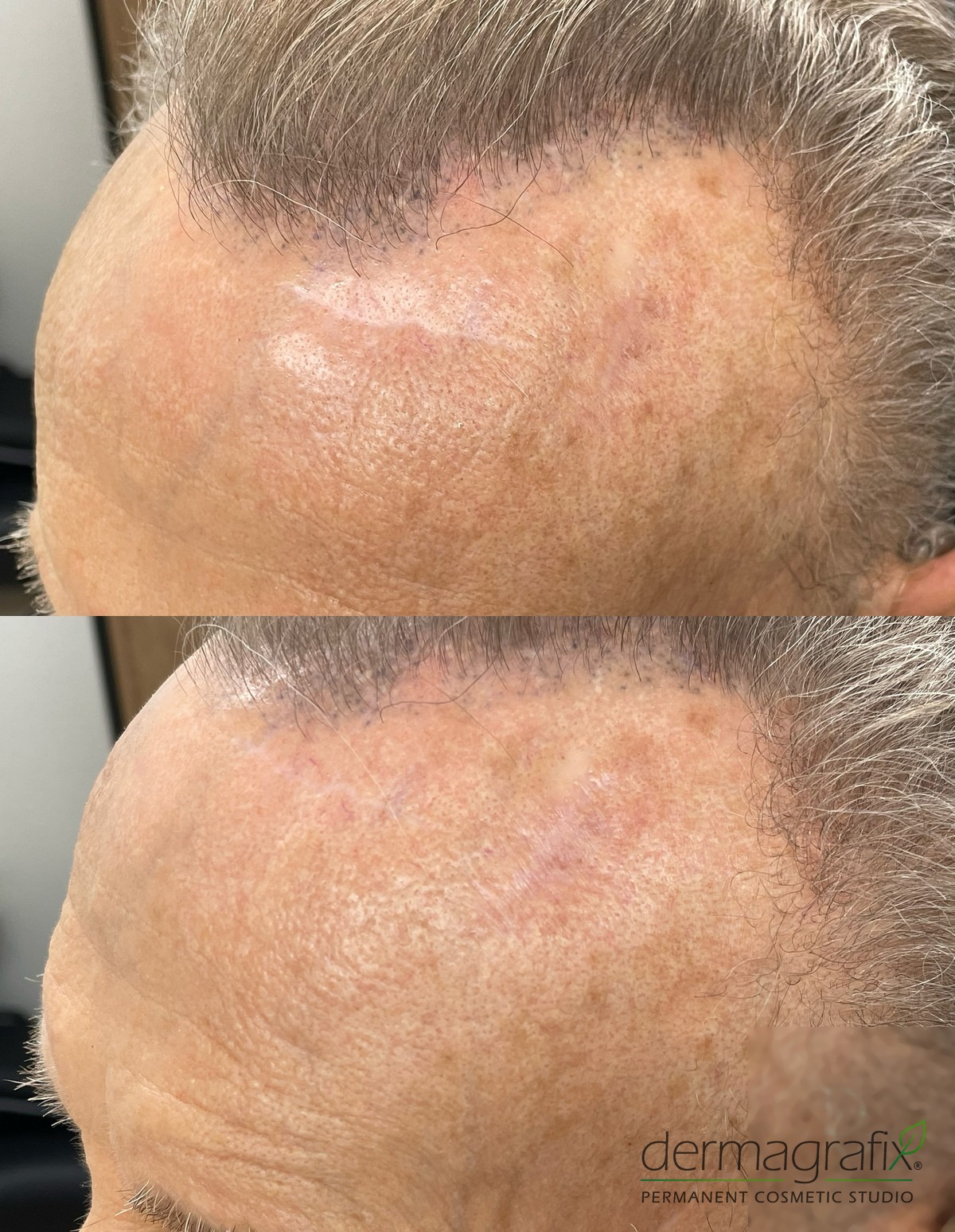 Forehead scar before and after scar re-pigmentation tattooing, blended into the surrounding skin tone